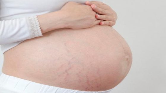 علاج نهائي للانميا عند الحامل