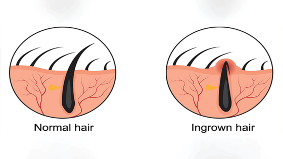 طريقة لإزالة الشعر تحت الجلد