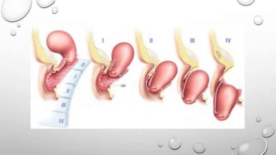 علاج هبوط الرحم في الطب النبوي