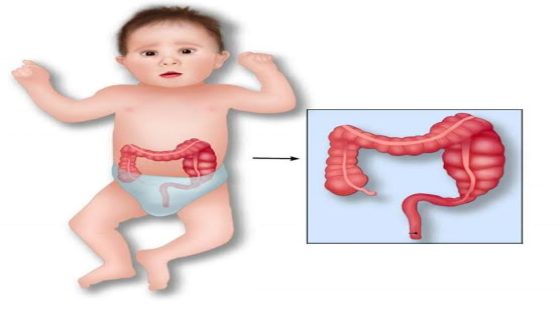 أسباب تهيج القولون للأطفال.. الأعراض والعلاج