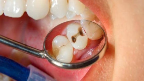 التخلص من تسوس الأسنان بطرق طبيعية