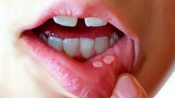 أسباب تقرحات الفم.. الأعراض والعلاج