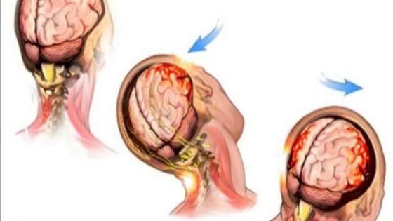 10 أعراض لارتجاج المخ.. تعرف عليها