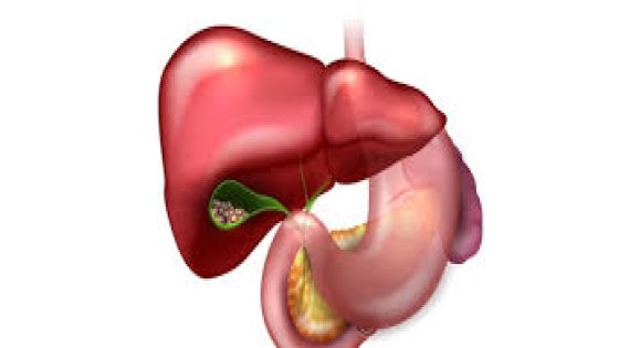 التهاب المرارة.. أسبابها وطرق العلاج